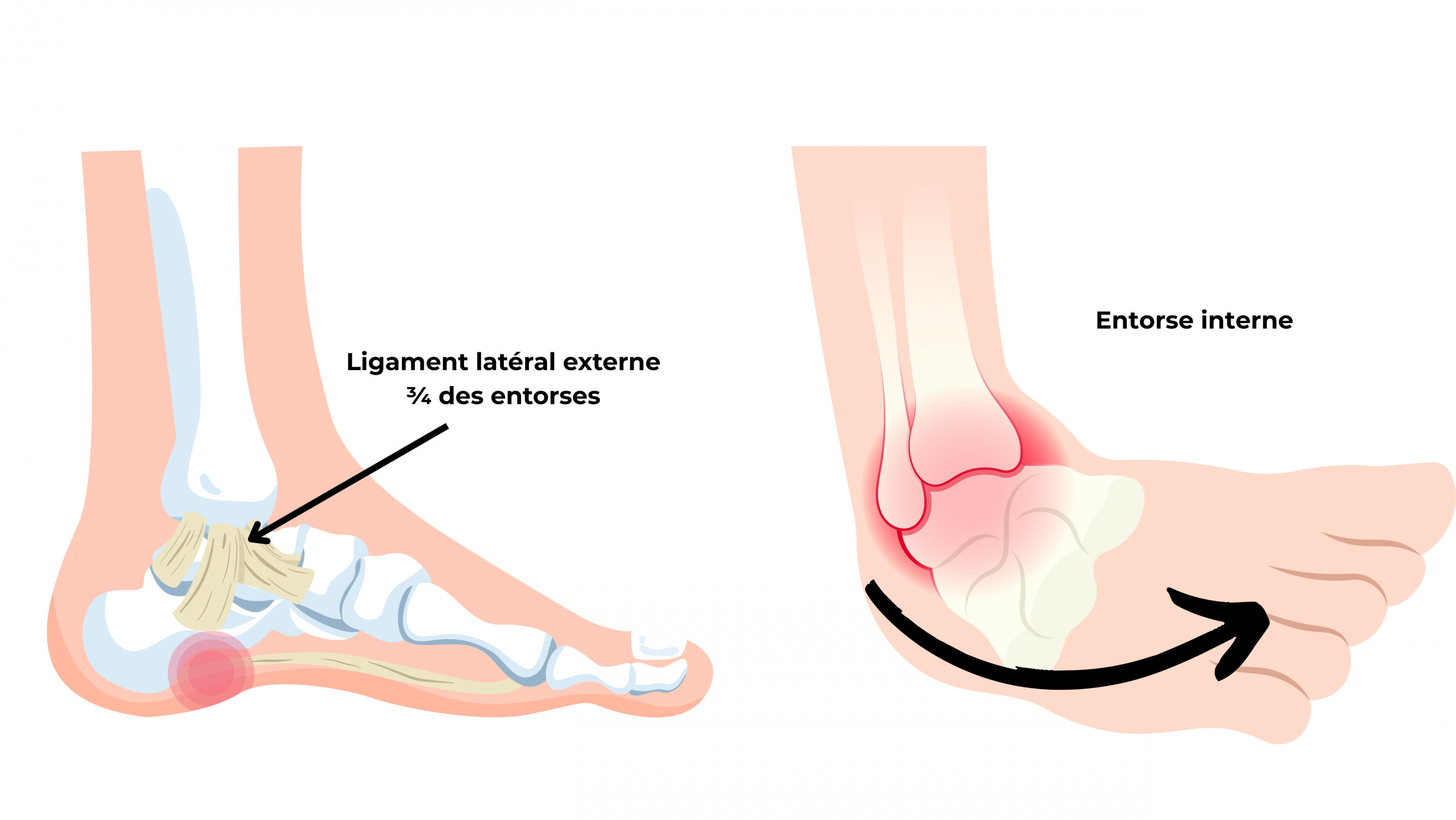 Schéma illustrant les zones touchées lors d’une entorse de cheville, avec le ligament latéral externe souvent atteint et l’entorse interne plus rare, utile pour comprendre les mécanismes des entorses et leur localisation.